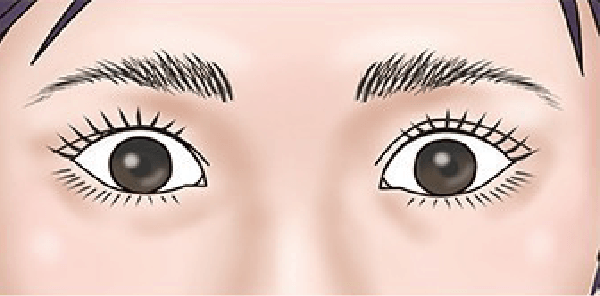 二重修正術 前の目元イラスト